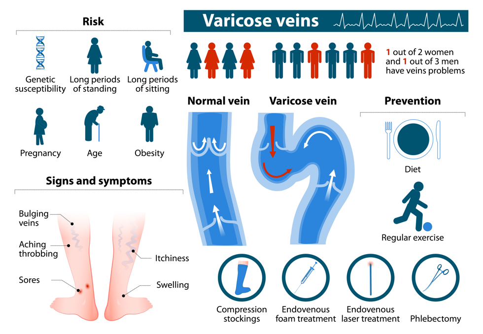 overview of varicose veins