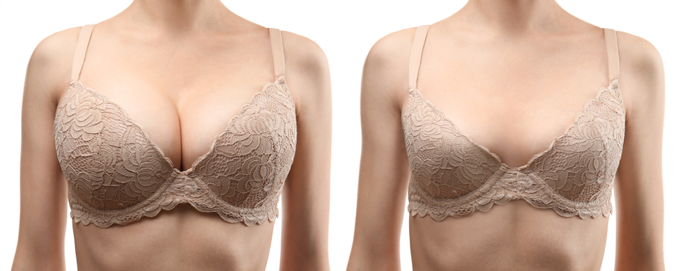 breast reduction before and after 