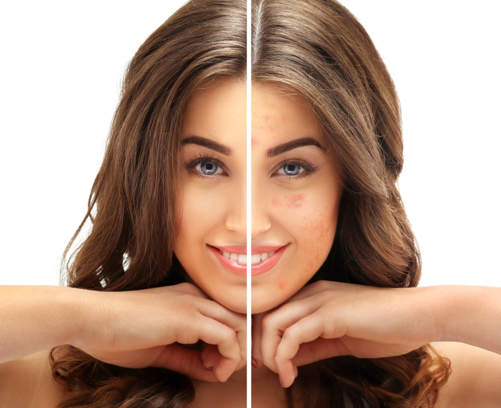 before and after dermabrasion