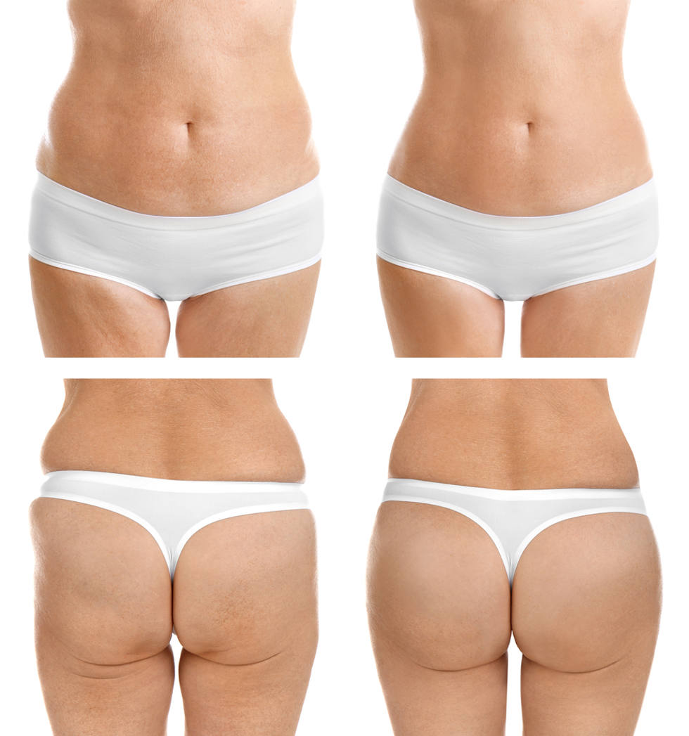 Before and After Vaser Liposuction