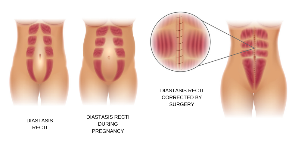 What is the Difference Between a Tummy Tuck and Liposuction?