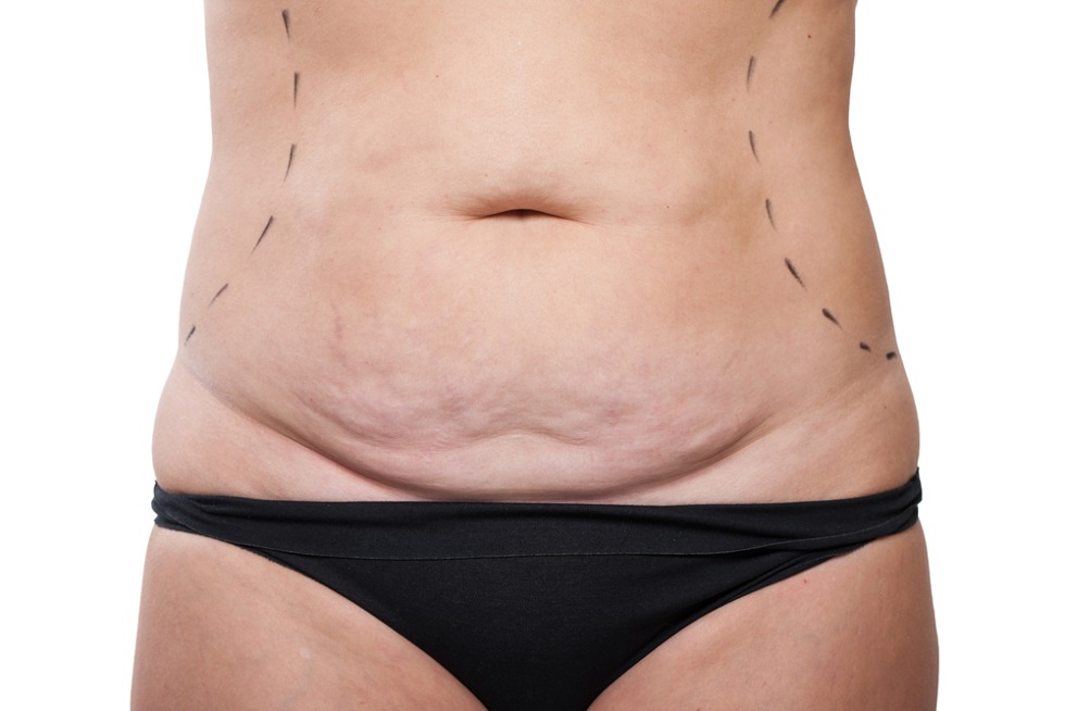 What is the Difference Between a Tummy Tuck and Liposuction?