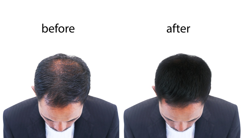 before and after a hair transplant 