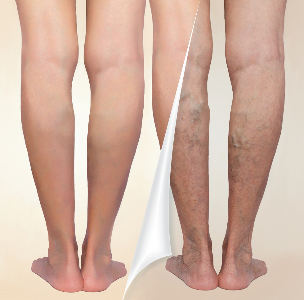 a varicose vein leg compared to a normal leg