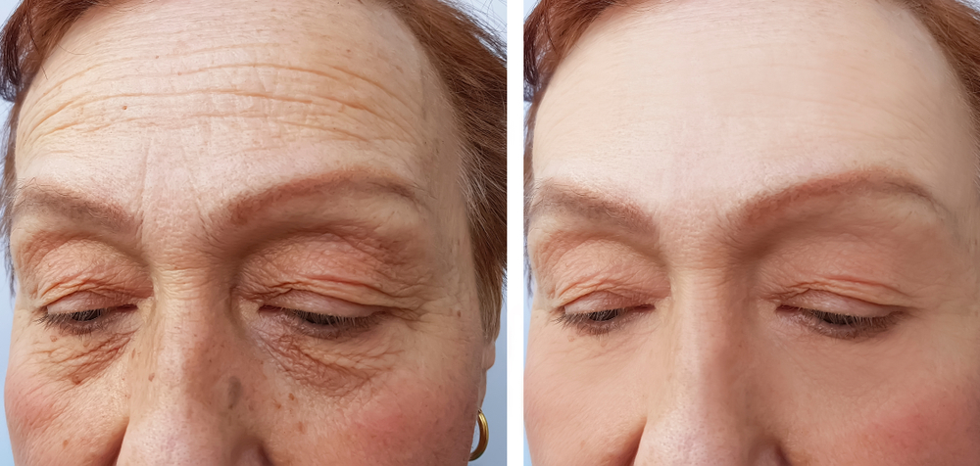 before and after of eyelid surgery