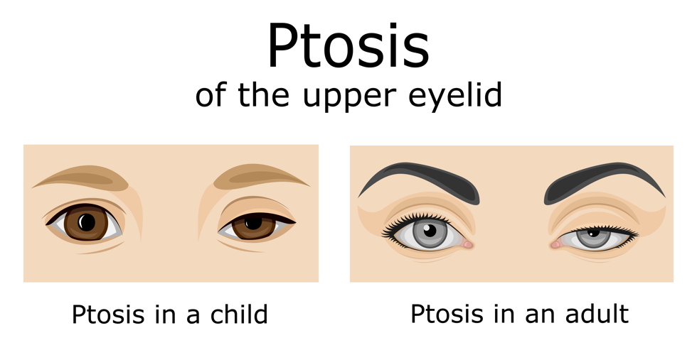 ptosis condition