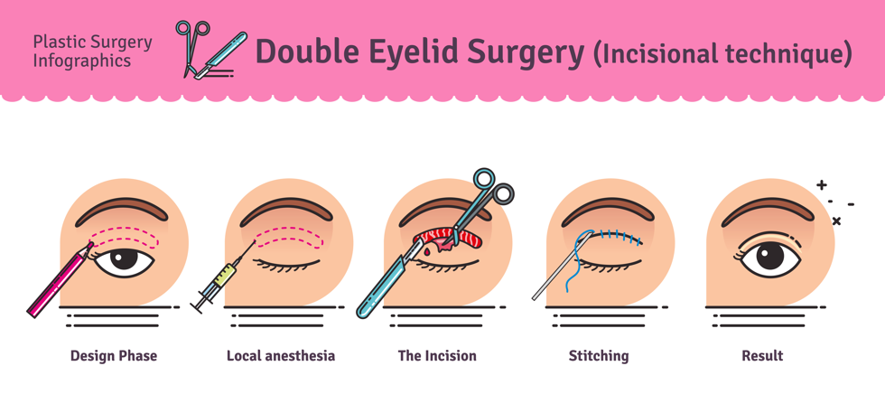 procedure of double eyelid surgery