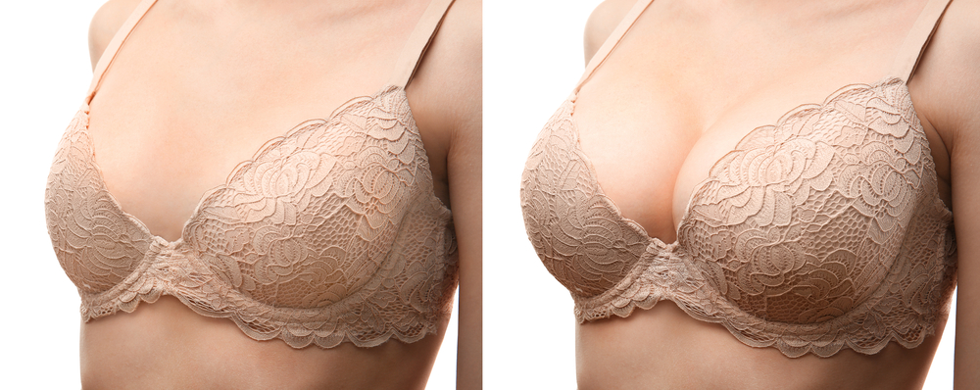 before and after breast reduction 