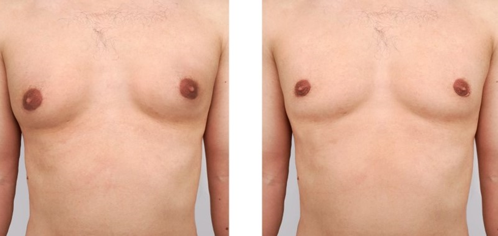 before and after breast reduction surgery