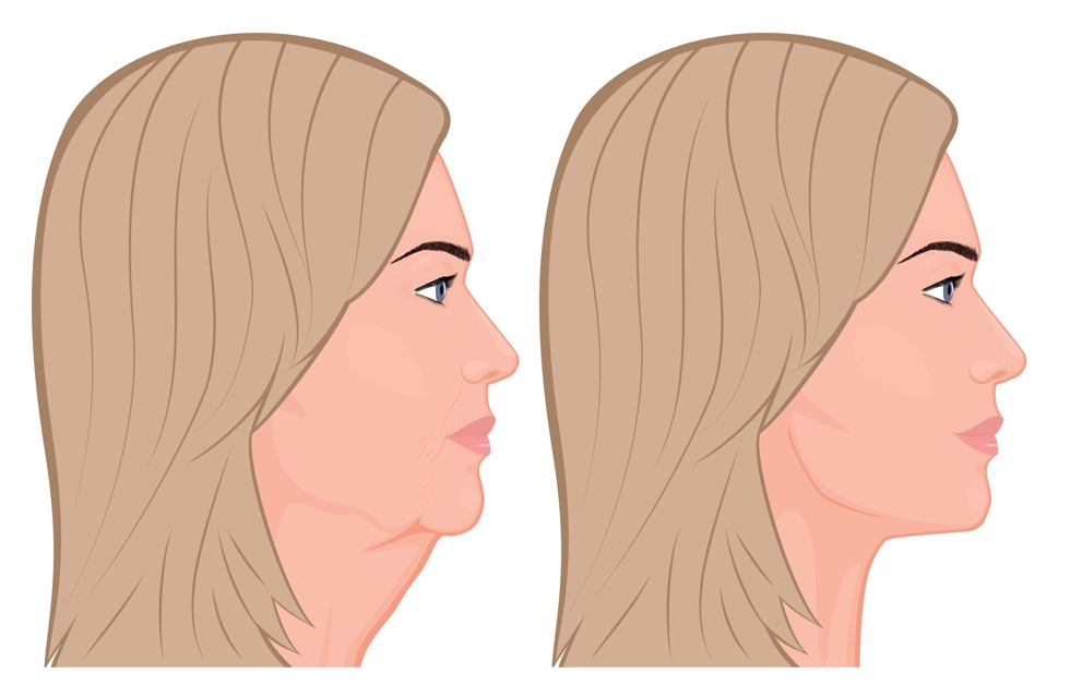 Surgery For Jawline: Procedure, Cost, And What To Expect, 42% OFF