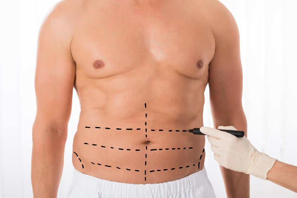 Abdominal Etching: Procedure, Cost, Recovery, and More