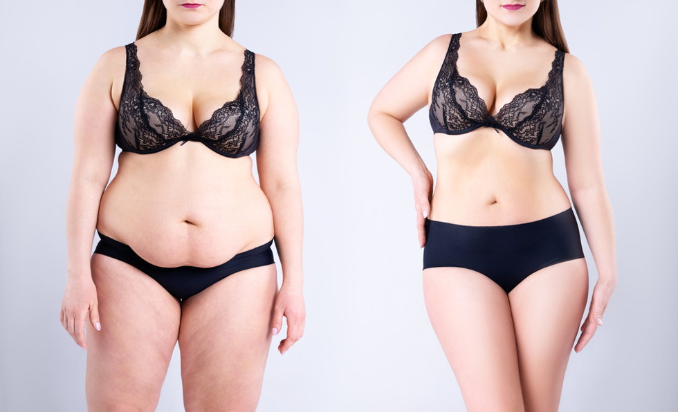 Tummy Tuck Surgery: Procedure, Risks & Side Effects - Raadina Health