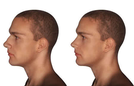 before and after nose reshaping in a man