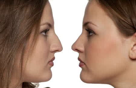 before and after nose reshaping in a women