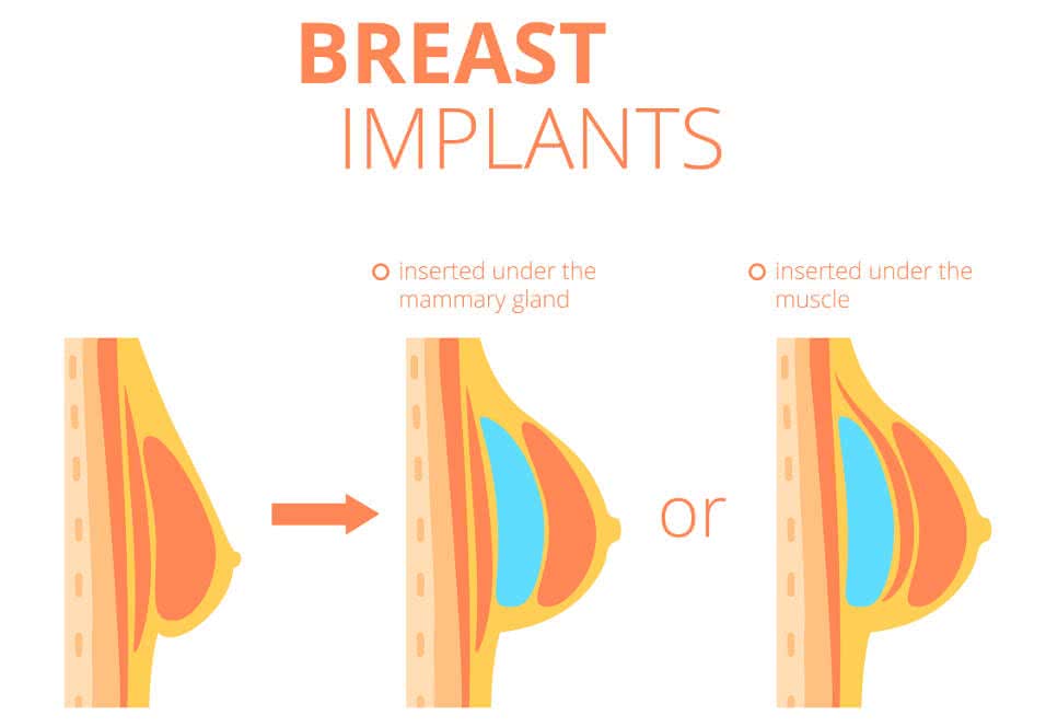 procedure of breast implants